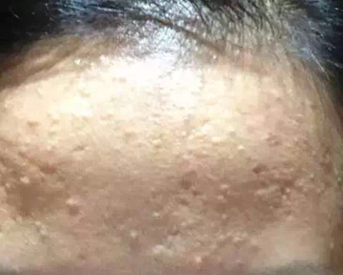 下巴的闭合性粉刺怎么消除,眉心闭合性粉刺最简单的消除方法