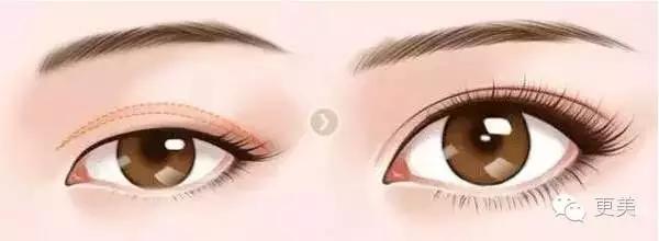 脸部自体脂肪填充术后多久消肿,自体脂肪填充术后多久有效果