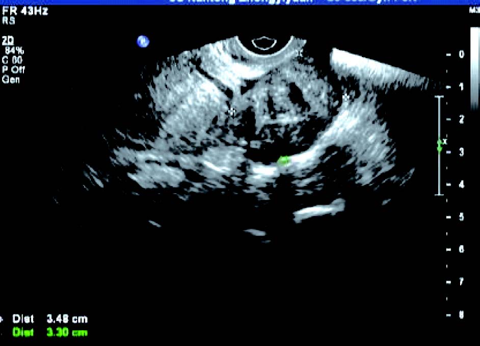 子宫圆韧带肌瘤的超声表现,子宫肌壁间肌瘤超声影像