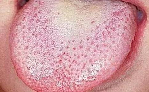6岁孩子地图舌草莓舌怎么回事,草莓舌锯齿舌和地图舌怎么缓解