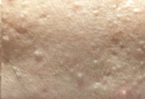 脸上老长闭合性粉刺是什么原因,脸上老是长闭合性粉刺是怎么回事