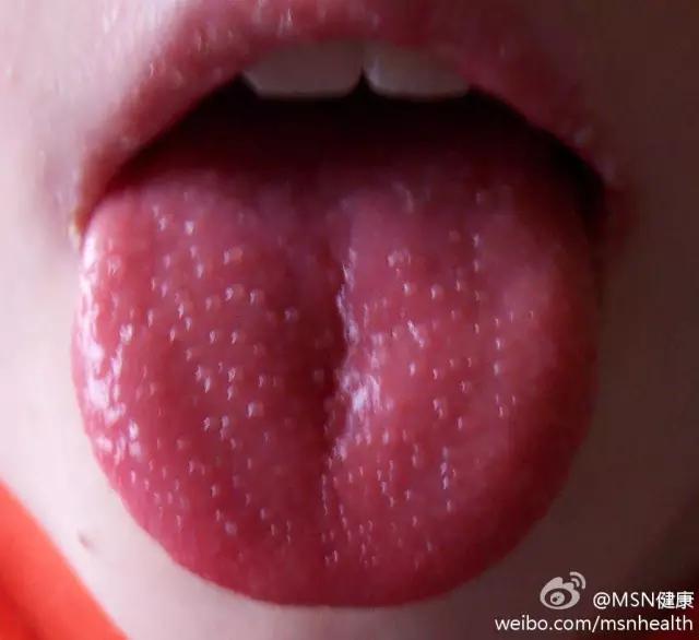 6岁孩子地图舌草莓舌怎么回事,草莓舌锯齿舌和地图舌怎么缓解