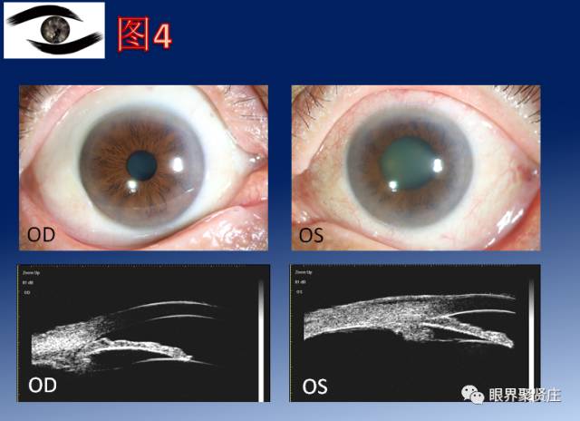 二十种眼型图解阴阳眼,青光眼能做九宫格眼底照相吗