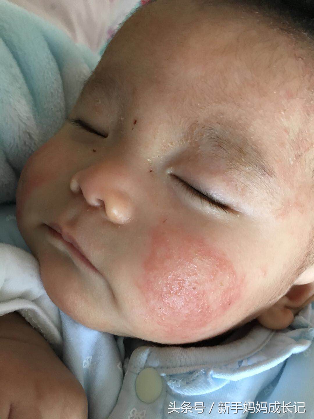 婴儿湿疹的分类及症状,湿疹多久变成慢性湿疹症状