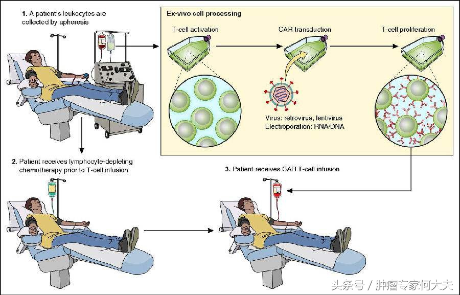 cart免疫疗法告捷治疗肿瘤案例,car-t细胞疗法治疗实体瘤