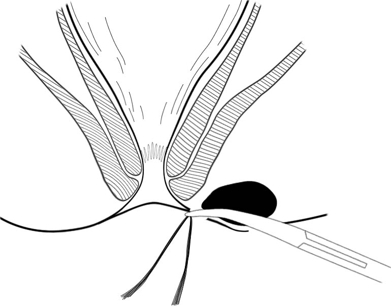 肛肠最新技术,人活一世难免会遇到各种糟心的事