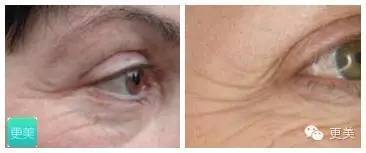 当青春变成了鱼尾纹,青春鱼尾纹