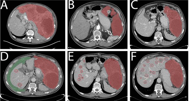 PubmedGIST文献月评第十四期（Jan.2018）