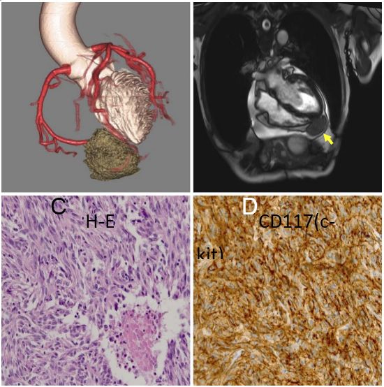 PubmedGIST文献月评第十四期（Jan.2018）