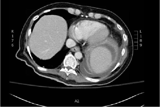 PubmedGIST文献月评第十四期（Jan.2018）