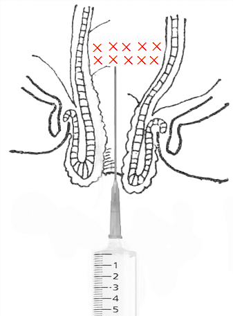 酸可收敛，涩可固脱，注射固脱技术让懂的人明白，医学需要创意