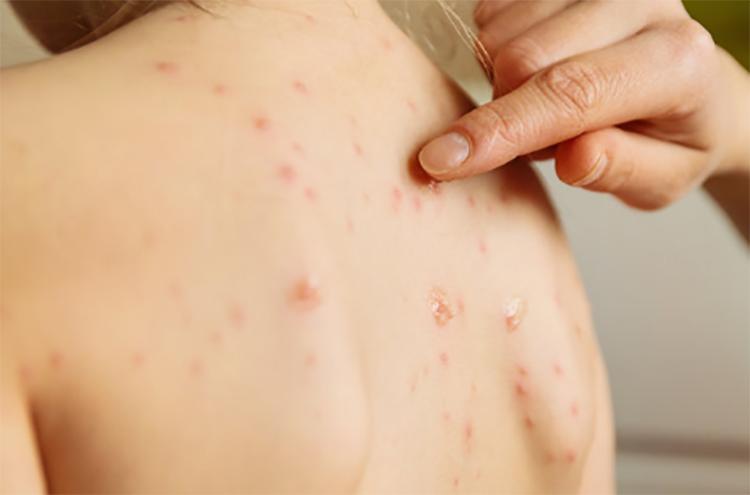 前胸后背长痘毛囊炎怎么办呢,怎样判断前胸后背长痘是毛囊炎