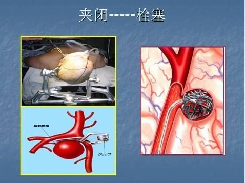 动脉瘤诊断与鉴别诊断,脑动脉瘤出血100ml手术预后