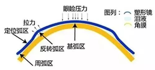 戴ok镜能恢复视力吗,ok镜能够永久矫正视力吗