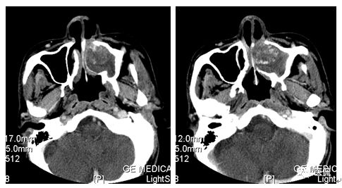 73岁患者无明显诱因出现左鼻塞、流脓涕，CT平扫发现密度影，怎么诊断？