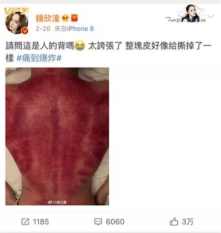 闃垮▏鏅掑埉鐥ф不鐤楃収,闃垮▏鑴搁儴鍒棫