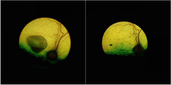 基因治疗最新突破有效果吗,基因疗法有望治愈的10种疾病