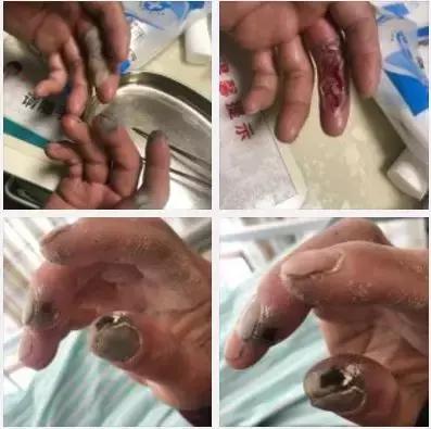 看着都疼！环卫工的手被强酸腐蚀，今天我们一起为他们倡议