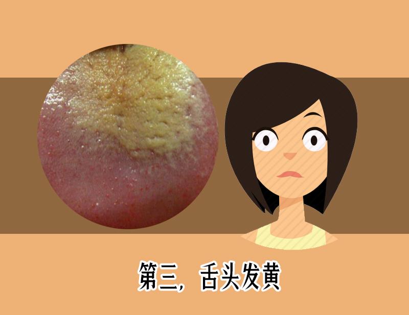 舌苔发黑辨证,舌苔整体发黄警惕四种原因