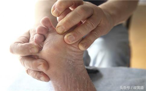 脚臭是不是得了脚气啊,脚臭和脚气有关联吗