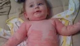 宝宝身上起丘疹麻疹怎么办,宝宝身上起荨麻疹一样的风团