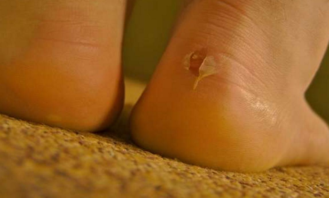 穿新鞋避免咬脚，不再破皮流血，保证让你像穿旧鞋那样舒服自在