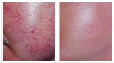 遗传性红血丝怎么祛除,遗传性的红血丝能够彻底祛除吗