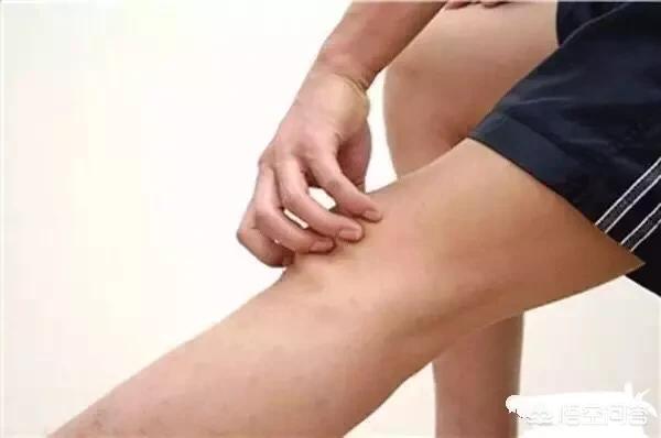 伤筋动骨100天吃药吗,伤筋动骨100天是必须躺100天吗