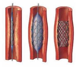 火视231|CookMedical：不断创新心血管介入治疗器械