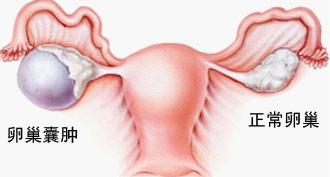 怀孕初期有囊肿会导致流产吗,小小的囊肿能够消失吗