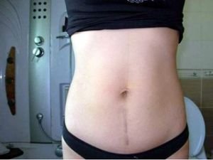 什么人不建议剖腹产,哪些人更合适剖腹产