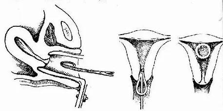 什么样的女性不合适上环,单身女性上环是什么心态