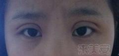 割双眼皮后悔的多还是不后悔的多,割双眼皮为什么前30天就那么难看