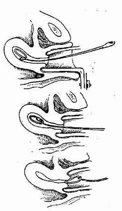 什么样的女性不合适上环,单身女性上环是什么心态
