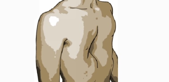 漏斗胸和沟状胸的区别,成人漏斗胸合并扁平胸导致气短