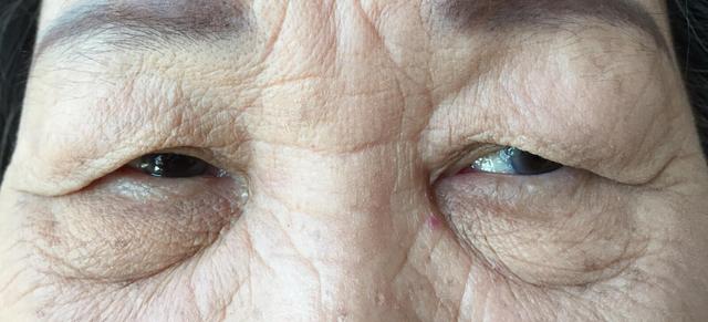 如何去除眼袋皱纹？养成好眼部的护理习惯