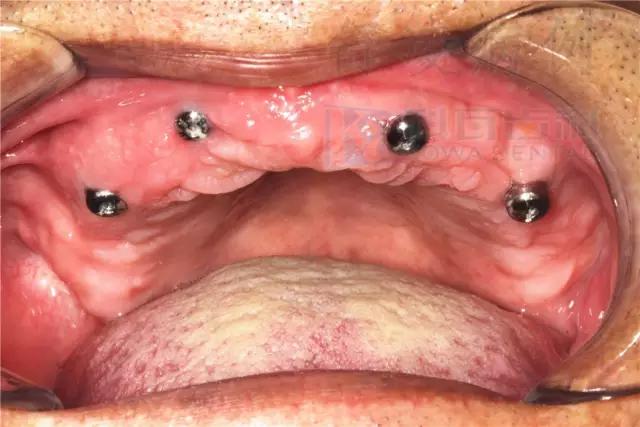 活动假牙戴不住，种植牙又嫌贵该怎么办？