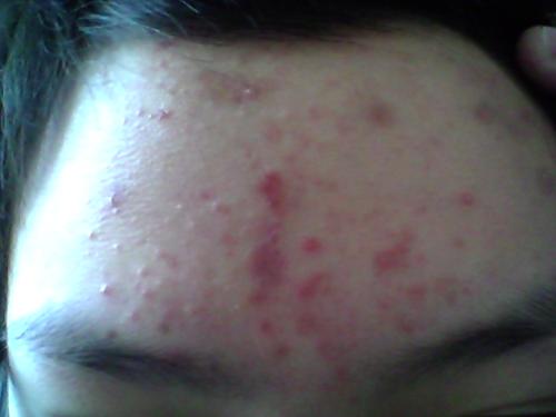 额头下巴长痘痘的原因和解决方法,额头长痘痘的原因和解决方法