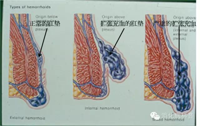 痔疮坐热凳子会传染吗,坐艾灸椅能够治痔疮吗