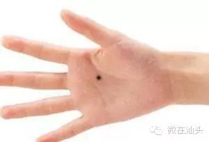 一图读懂什么样的痣易癌变,点痣后增生了肉痣会变癌吗