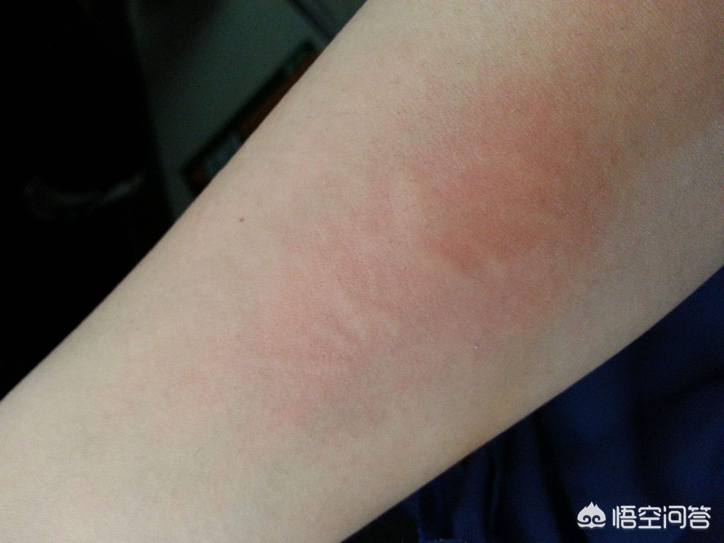 支气管哮喘能根治吗有什么方法,支气管哮喘能不能彻底治愈