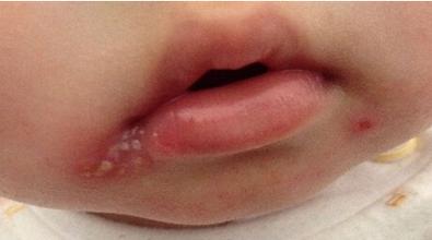 嘴唇上火长泡,变成黑印怎么办？学会自己去火，去黑印