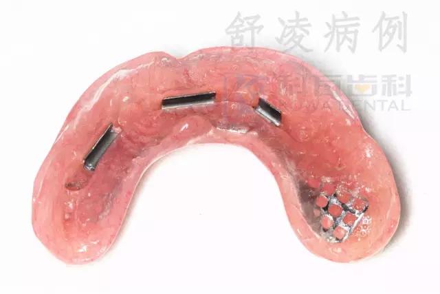 活动假牙戴不住，种植牙又嫌贵该怎么办？