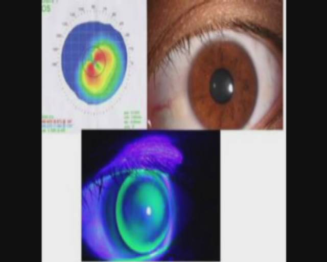 记者体验治疗近视,治疗近视的真实案例