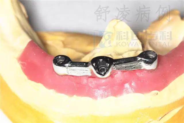 活动假牙戴不住，种植牙又嫌贵该怎么办？