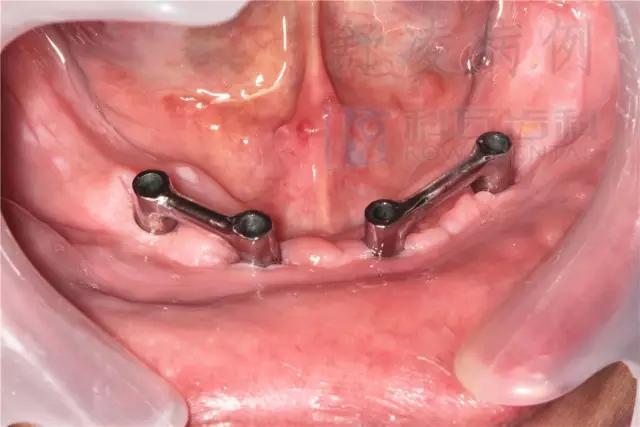 活动假牙戴不住，种植牙又嫌贵该怎么办？