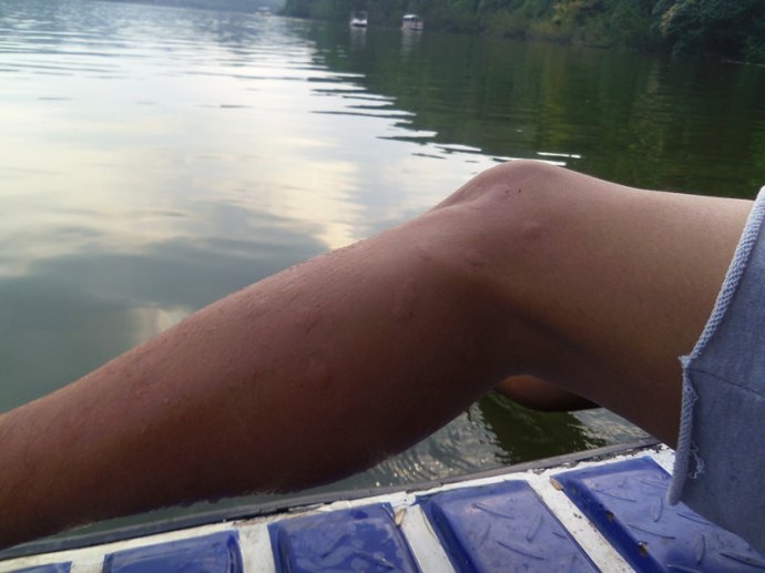 你被蚊子咬了吗是什么梗,四川墨蚊咬了以后怎么治疗