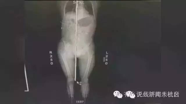 济南男子被1米长钢筋从阴部穿到脑部30名行家开颅开胸开腹手术7小时保住命