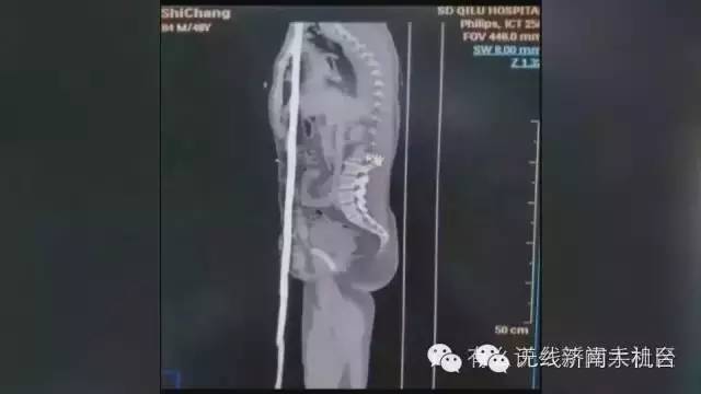 济南男子被1米长钢筋从阴部穿到脑部30名行家开颅开胸开腹手术7小时保住命