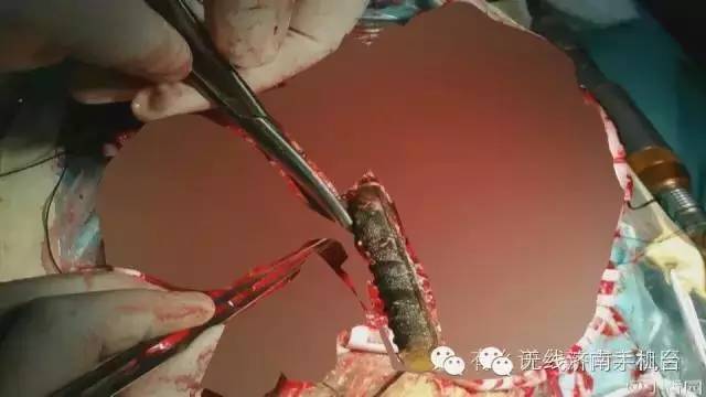 济南男子被1米长钢筋从阴部穿到脑部30名行家开颅开胸开腹手术7小时保住命